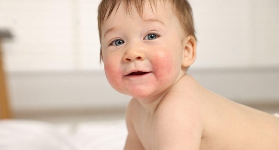 How to Identify and Treat Baby Eczema Early